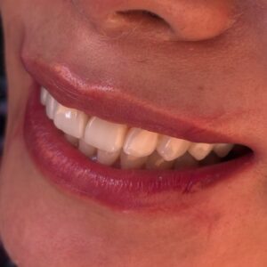 Blanqueamiento Dental